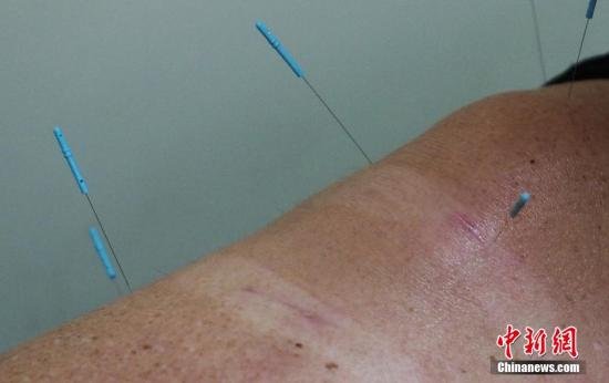 图为在美国行医20余年，身为清代著名中医温病学家吴鞠通的第七代传人的吴宝林为患者针灸。中新社发 毛建军 摄